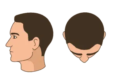 Stage 1 - Minimal to no hair loss