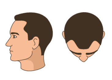 Stage 2 - Slight temple recession