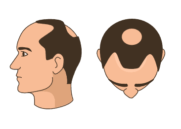Stage 3 - Moderate recession with crown thinning