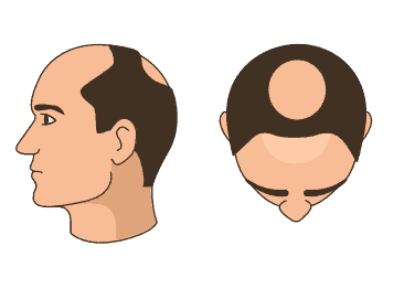 Stage 4 - Significant hair loss