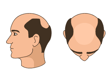 Stage 5+ - Advanced hair loss
